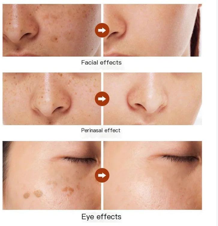 Herbal Astragalus Cream for Dark Spot Removal